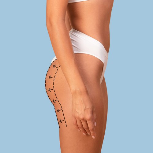 https://idoweb.me/images/services/gluteal-augmentation.jpg